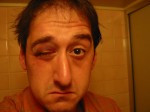 Richard's got them old black-eyed blues!